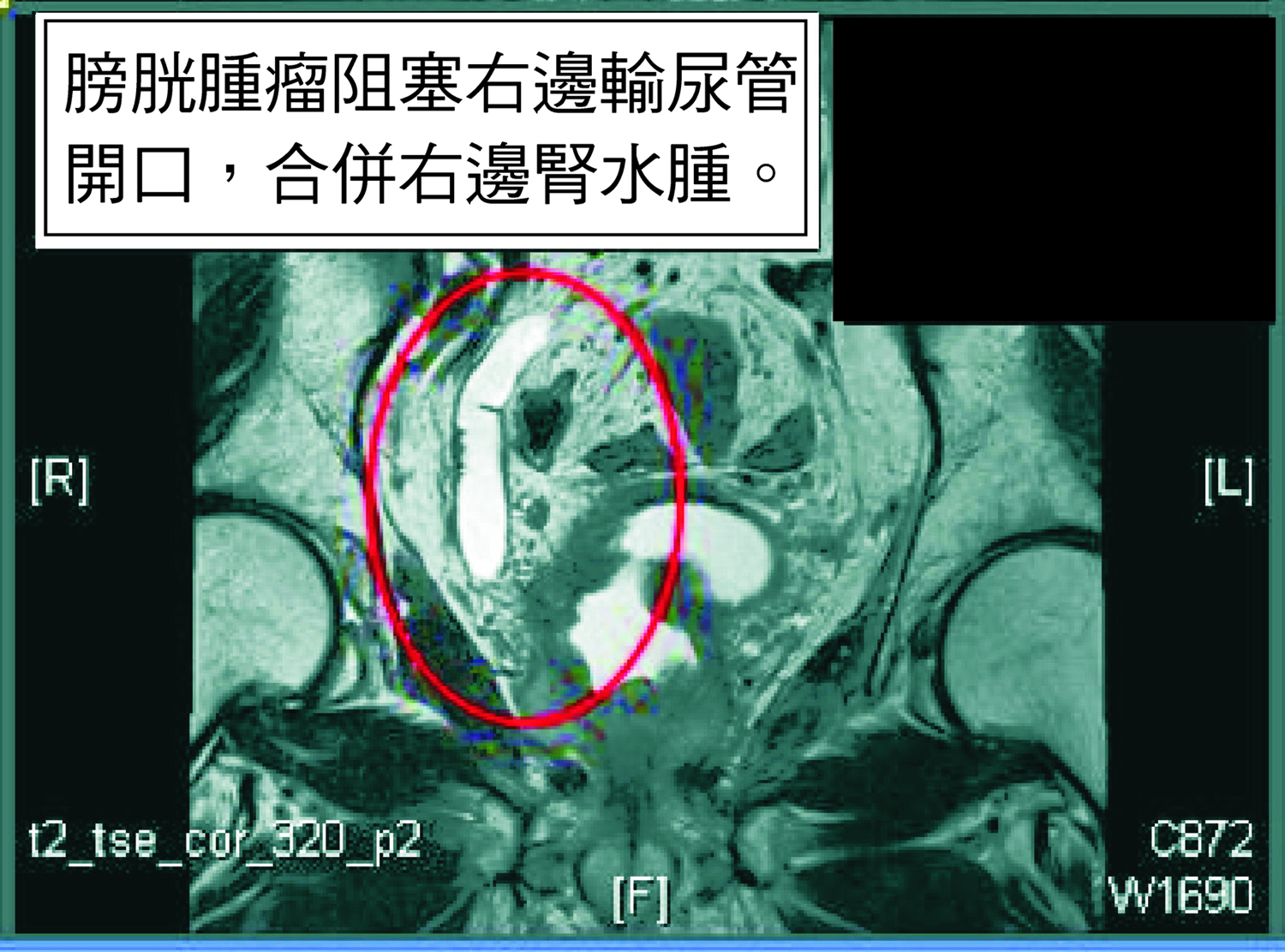 膀胱癌反覆復發　免疫療法治療見效