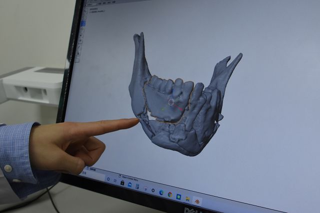 彰基3D列印　重建騎車自摔男大生顏面下顎骨