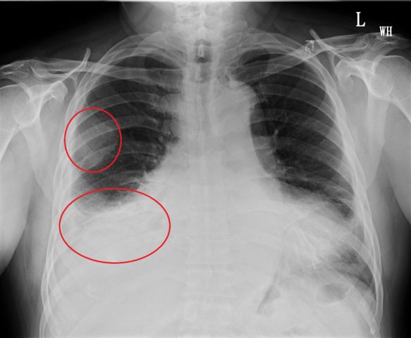 呼吸胸痛又反覆高燒　當心是胸腔內蓄膿